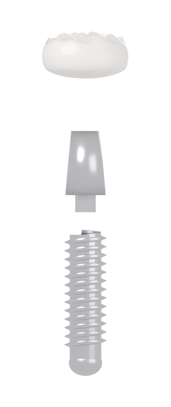 Vue éclatée d'un implant dentaire : la couronne en céramique, le pilier, et l'implant en titane vissé dans l'os.